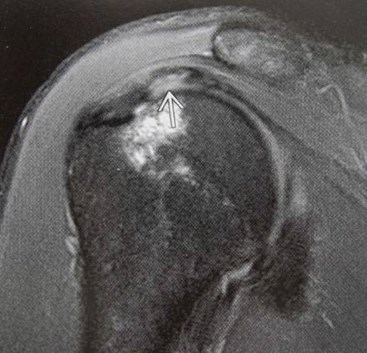 arthritis arthrogram joint x ray arthritis arthrogram joint x ray